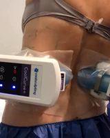 Coolsculpting Body Contouring Picture By Dr. Randolph Capone, Baltimore Plastic Surgeon